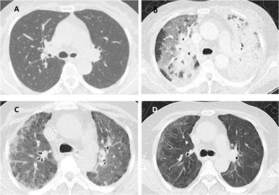 Extracorporeal Membrane Oxygenation Supported Transbronchial Cryobiopsy in the Diagnosis of Severe Organizing Pneumonia: A Case Report